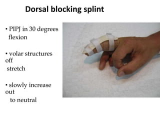 Dorsal blocking splint
• PIPJ in 30 degrees
flexion
• volar structures
off
stretch
• slowly increase
out
to neutral
 