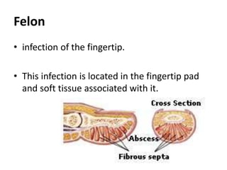 Felon
• infection of the fingertip.
• This infection is located in the fingertip pad
and soft tissue associated with it.
 