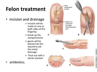 Felon treatment
• incision and drainage
» incision will be
made on one or
both sides of the
fingertip.
» break up the
compartments
» gauze will be
placed into the
wound to aid
the initial
drainage.
» flush out with a
sterile solution
• antibiotics.
 