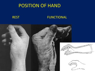 hand injury presentation to be use in safety comaign | PPT