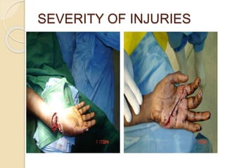 SEVERITY OF INJURIES
 