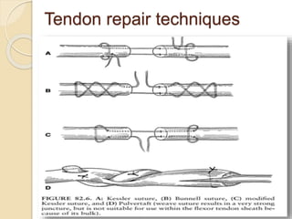 Tendon repair techniques
 