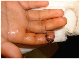 Hand injury | PPTX