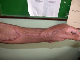 Post Driver Hand Injury Hand injury | PPTX
