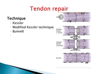 Kessler Approach Hand injury | PPTX