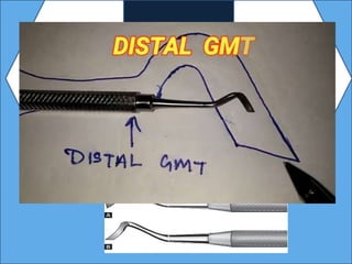 Hand instruments in operative dentistry | PPT
