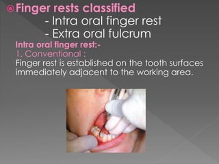 Finger rests classified
- Intra oral finger rest
- Extra oral fulcrum
Intra oral finger rest:-
1. Conventional :
Finger rest is established on the tooth surfaces
immediately adjacent to the working area.
 