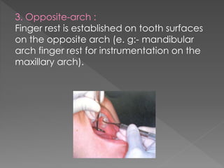 3. Opposite-arch :
Finger rest is established on tooth surfaces
on the opposite arch (e. g:- mandibular
arch finger rest for instrumentation on the
maxillary arch).
 