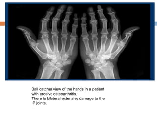 radiology of hand in systemic diseases ppt | PPTX