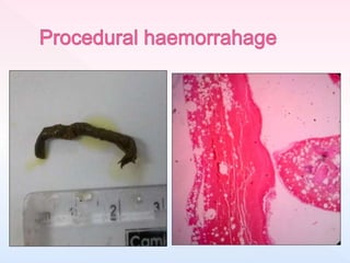 processing of bone marrow trephine biopsy | PPTX