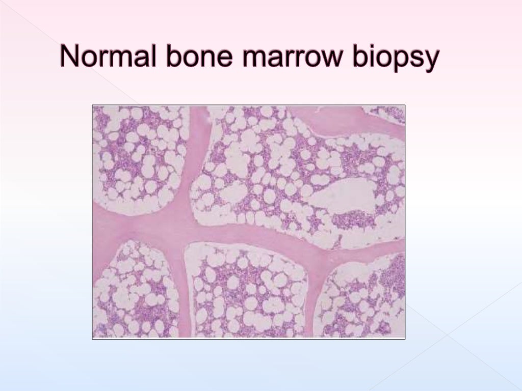processing-of-bone-marrow-trephine-biopsy