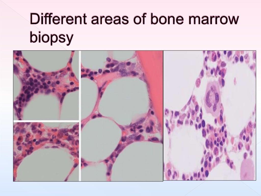 processing-of-bone-marrow-trephine-biopsy