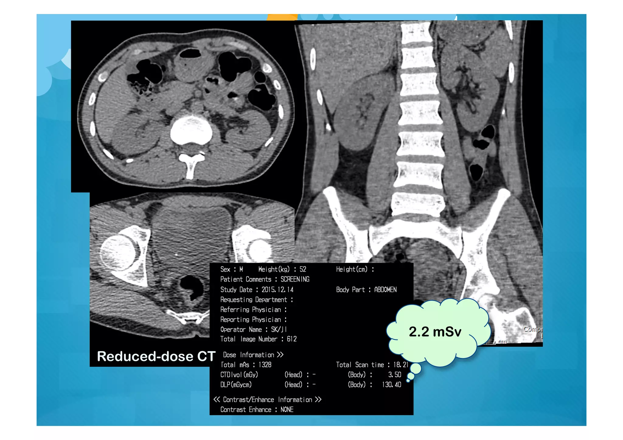 2.2 mSv
Reduced-dose CT
 