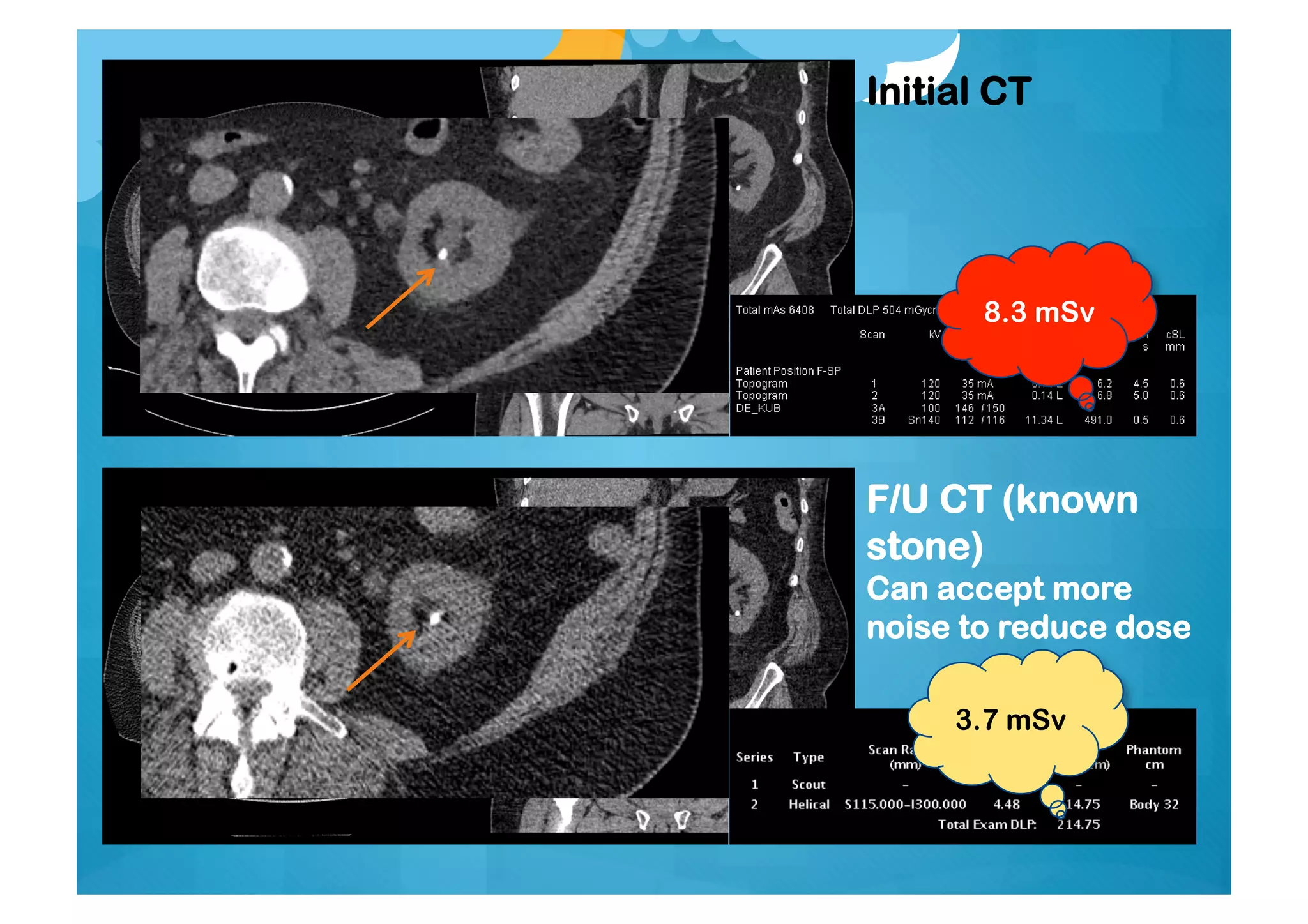 Initial CT
F/U CT (known
stone)
Can accept more
noise to reduce dose
8.3 mSv
3.7 mSv
 
