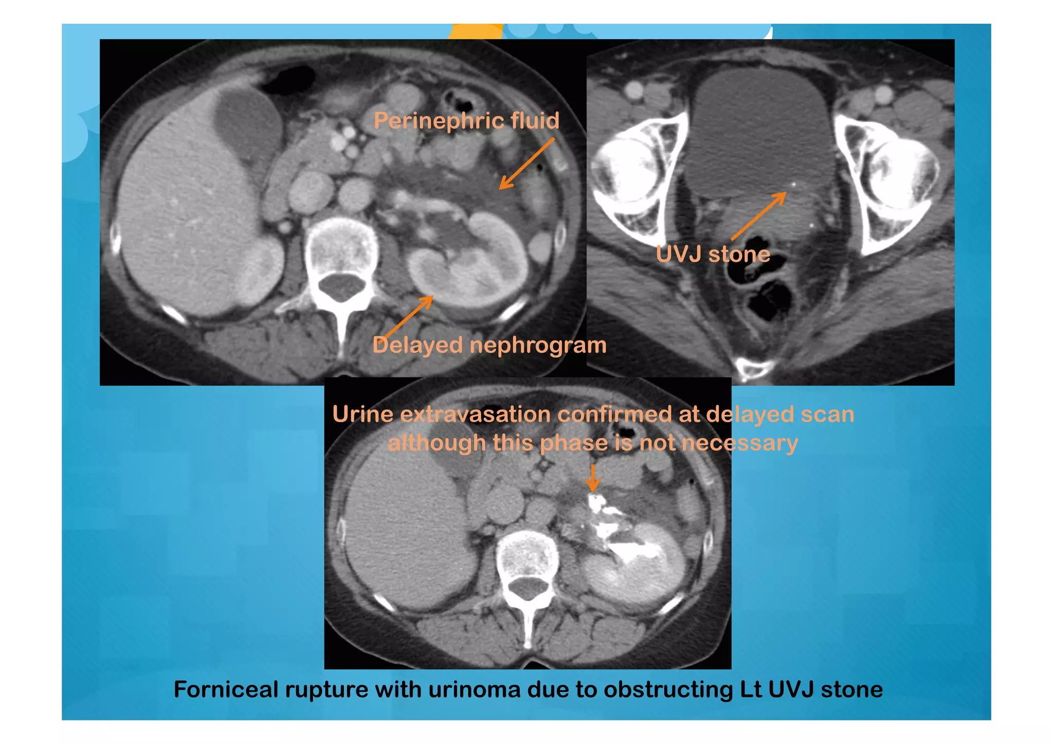 Forniceal rupture with urinoma due to obstructing Lt UVJ stone
UVJ stone
Delayed nephrogram
Perinephric fluid
Urine extravasation confirmed at delayed scan
although this phase is not necessary
 