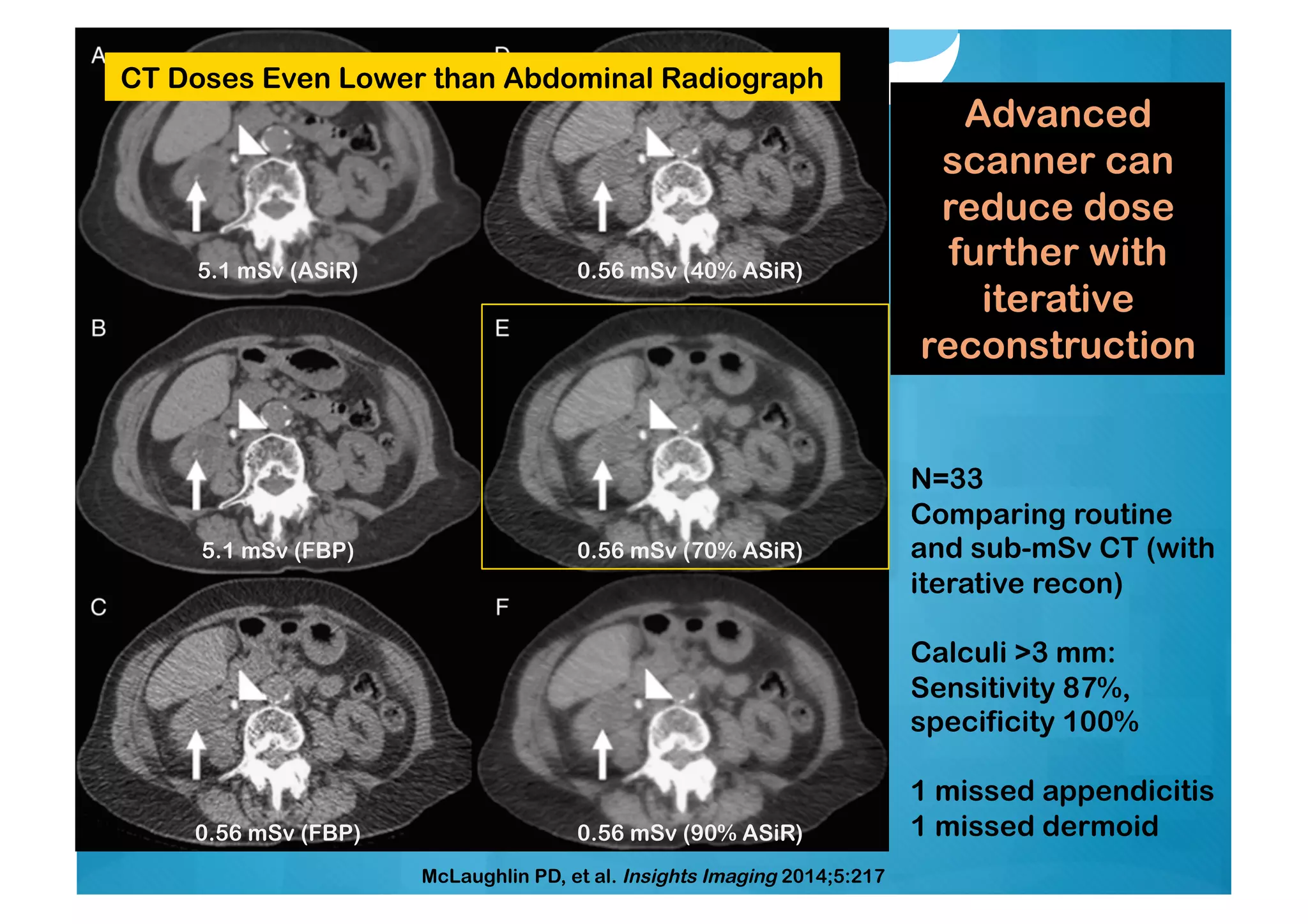 McLaughlin PD, et al. Insights Imaging 2014;5:217
5.1 mSv (ASiR)
5.1 mSv (FBP)
0.56 mSv (FBP)
0.56 mSv (40% ASiR)
0.56 mSv (70% ASiR)
0.56 mSv (90% ASiR)
CT Doses Even Lower than Abdominal Radiograph
N=33
Comparing routine
and sub-mSv CT (with
iterative recon)
Calculi >3 mm:
Sensitivity 87%,
specificity 100%
1 missed appendicitis
1 missed dermoid
Advanced
scanner can
reduce dose
further with
iterative
reconstruction
 