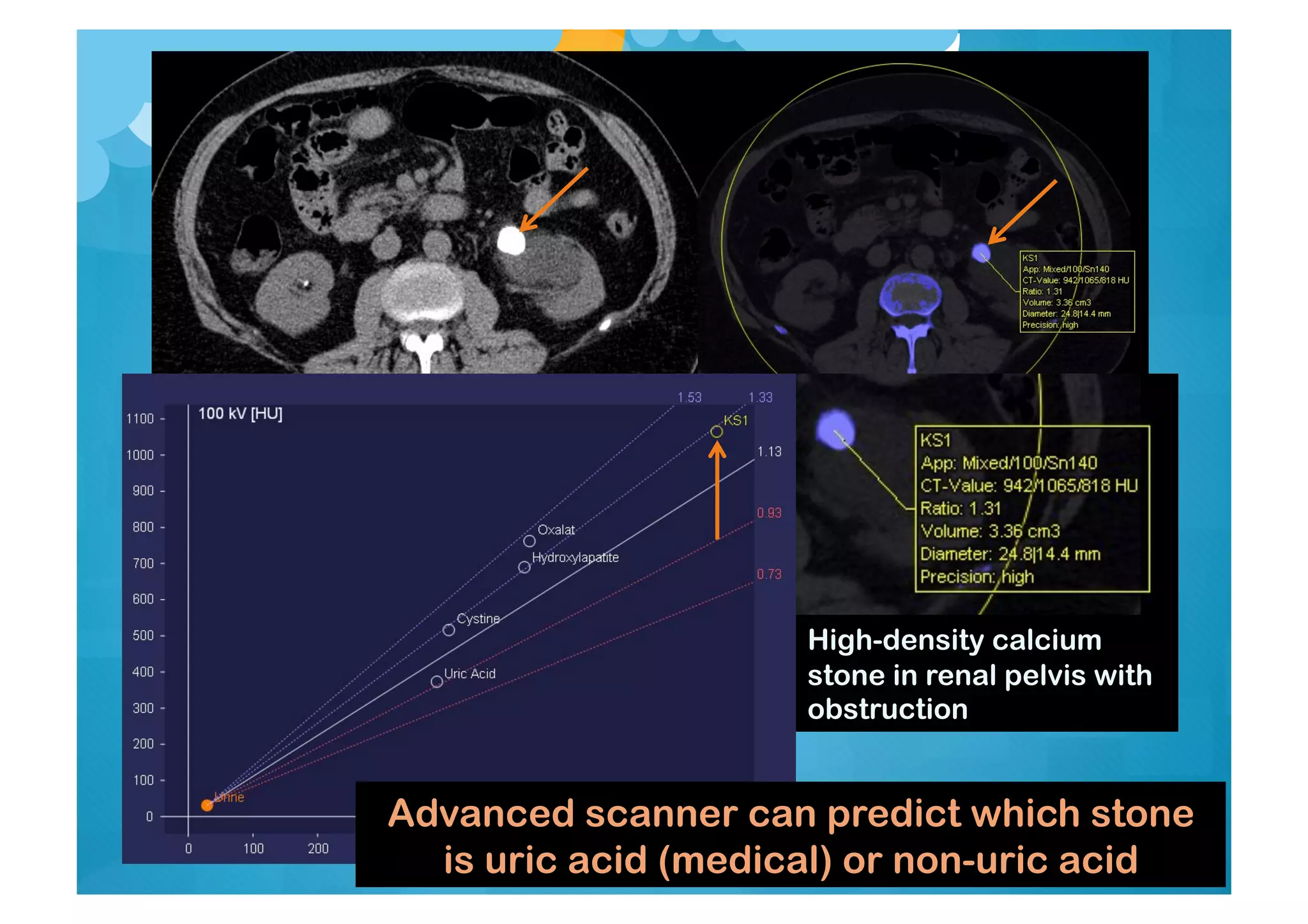 High-density calcium
stone in renal pelvis with
obstruction
Advanced scanner can predict which stone
is uric acid (medical) or non-uric acid
 