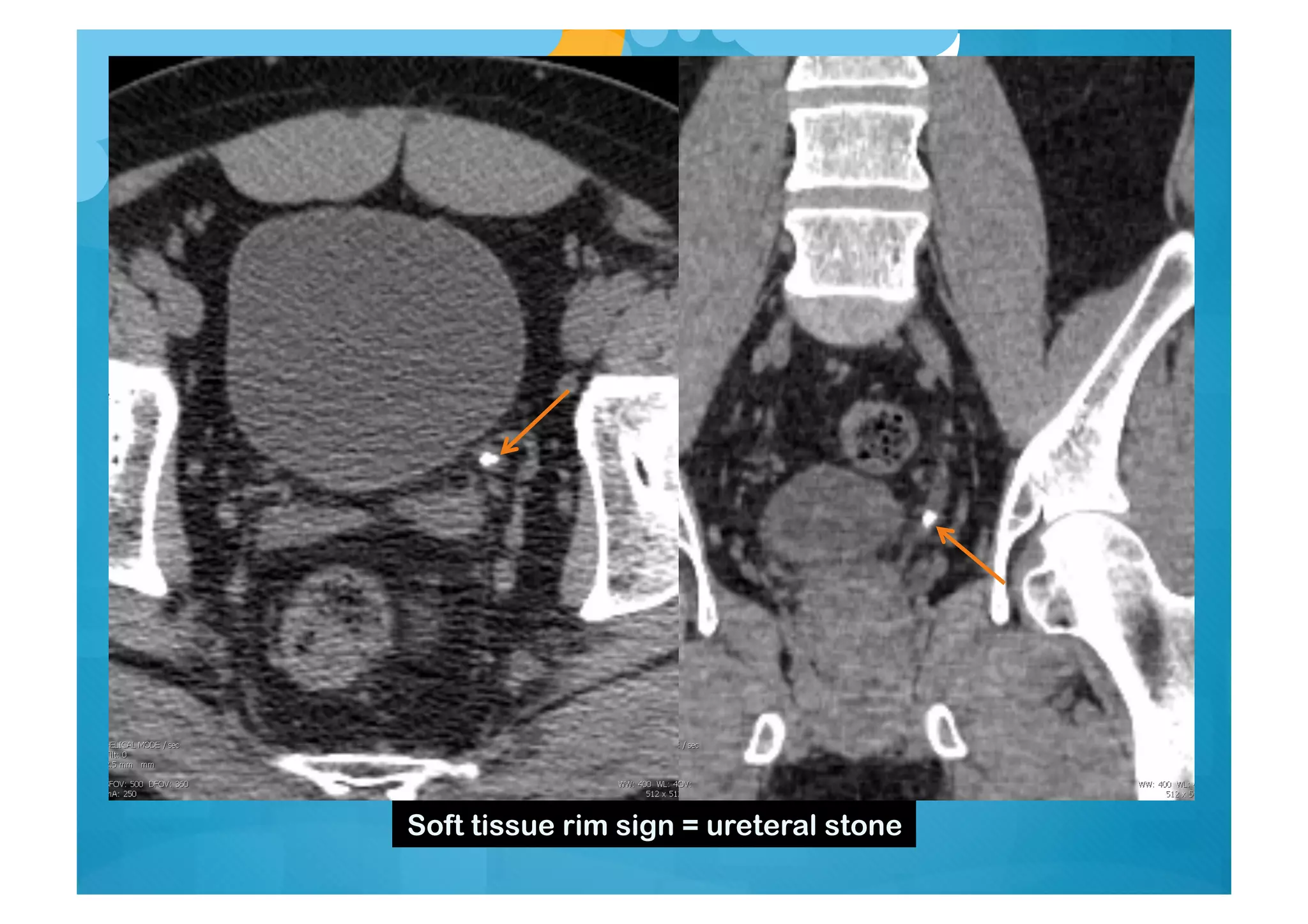 Soft tissue rim sign = ureteral stone
 