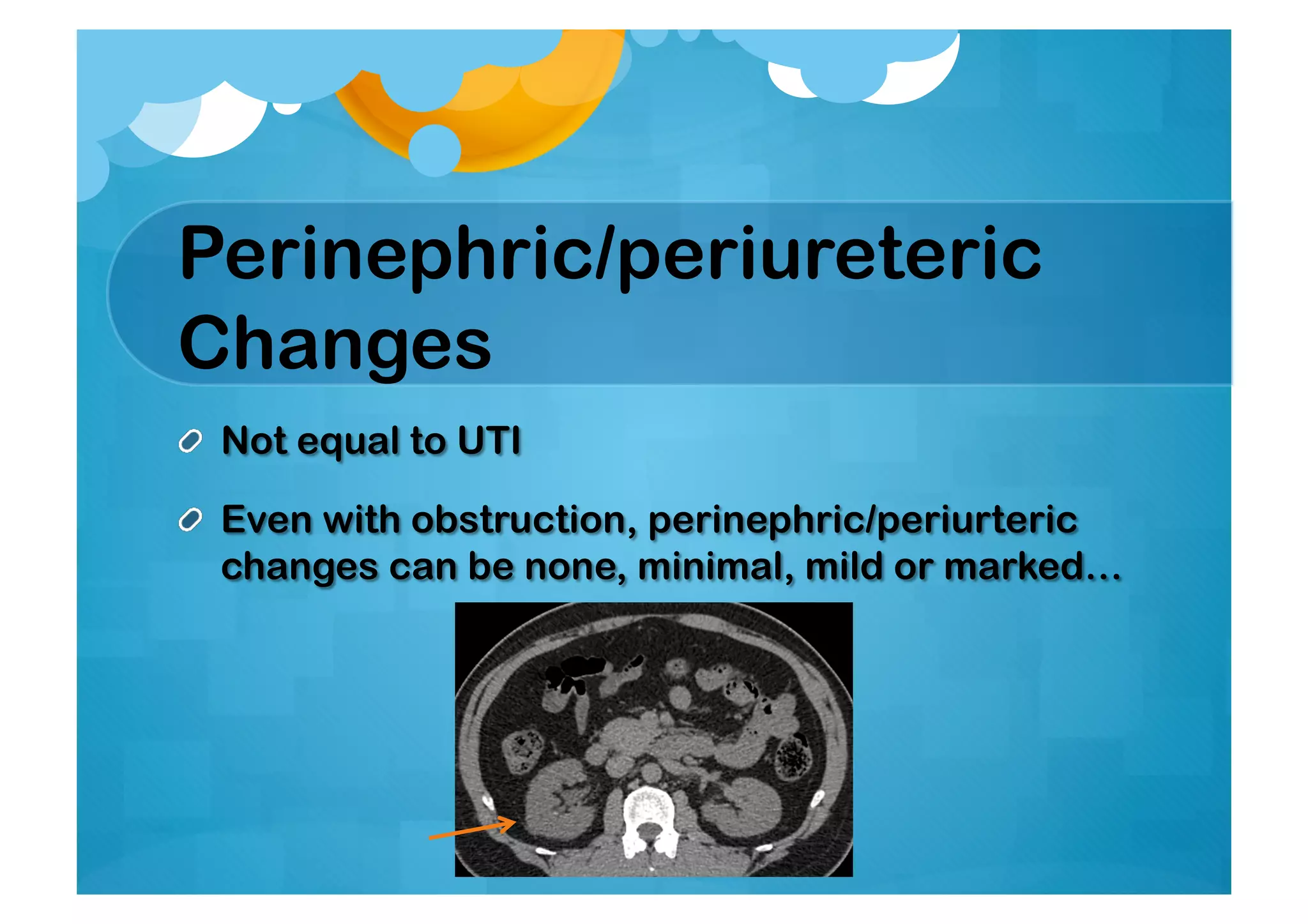 Perinephric/periureteric
Changes
 