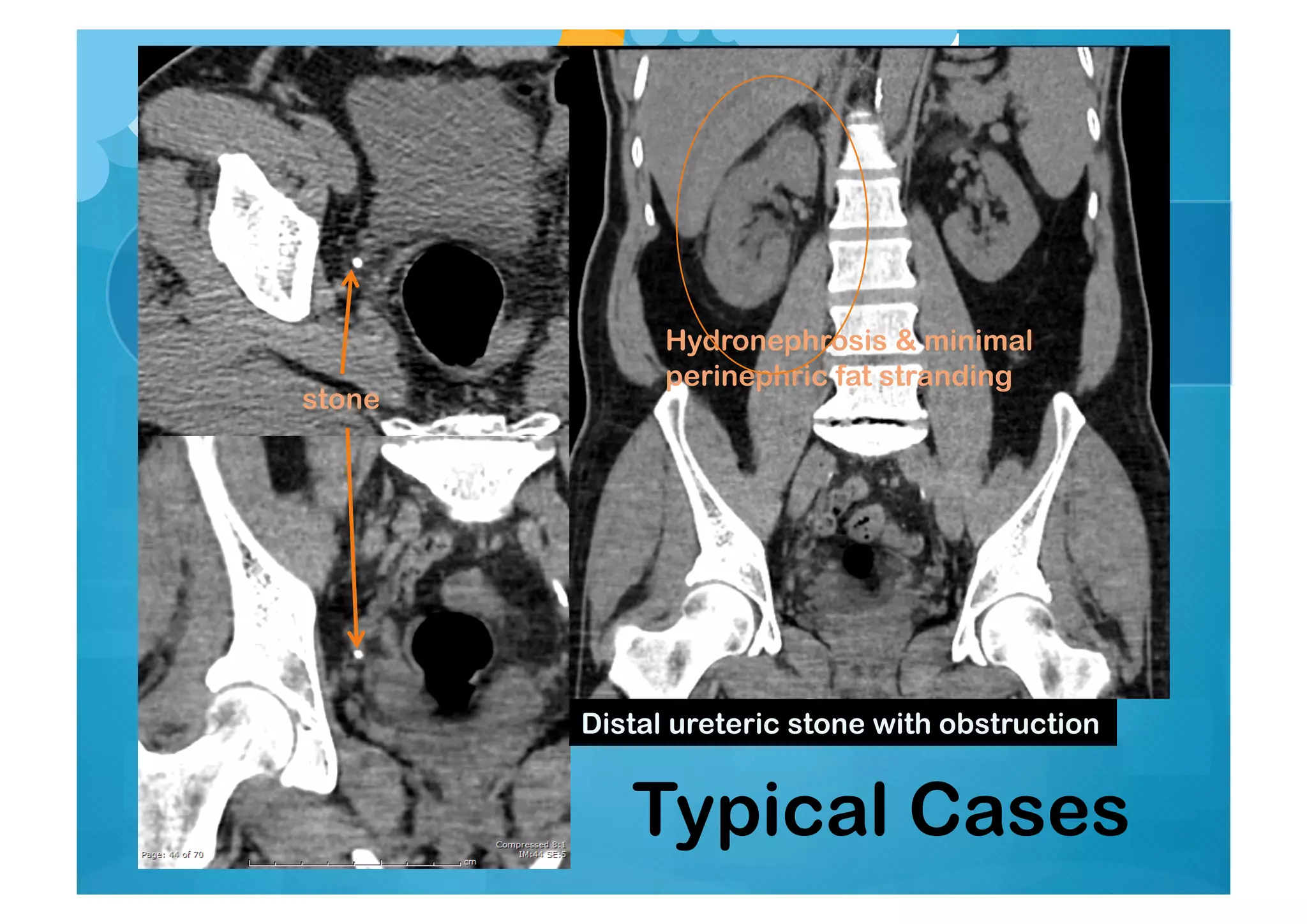 Distal ureteric stone with obstruction
Typical Cases
Hydronephrosis & minimal
perinephric fat stranding
stone
 