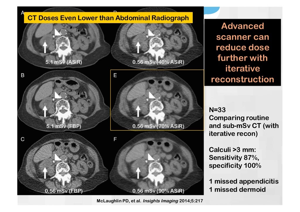Stone protocol CT Why, How and Pitfalls