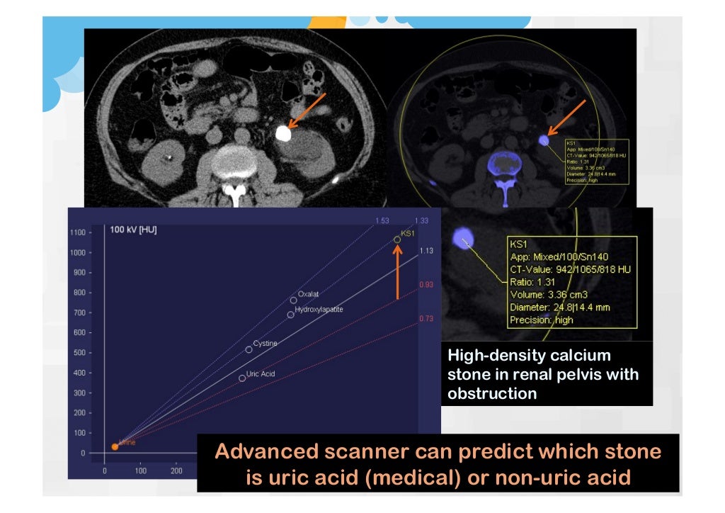 Stone protocol CT Why, How and Pitfalls