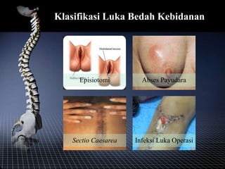 Klasifikasi Luka Bedah Kebidanan
Episiotomi Abses Payudara
Sectio Caesarea Infeksi Luka Operasi
 