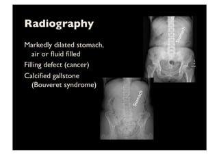 Radiography	

Markedly dilated stomach,
air or ﬂuid ﬁlled	

Filling defect (cancer)	

Calciﬁed gallstone
(Bouveret syndrome)	

 