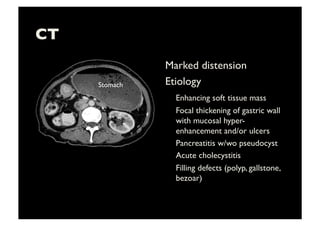 CT	

Marked distension	

Etiology	

	

Enhancing soft tissue mass	

	

Focal thickening of gastric wall
with mucosal hyper-
enhancement and/or ulcers	

	

Pancreatitis w/wo pseudocyst	

	

Acute cholecystitis	

	

Filling defects (polyp, gallstone,
bezoar)	

Stomach	

 