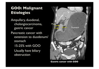 GOO: Malignant 
Etiologies	

Ampullary, duodenal,
cholangiocarcinoma,
gastric cancer	

Pancreatic cancer with
extension to duodenum/
stomach	

	

15-25% with GOO	

	

Usually have biliary
obstruction	

Stomach	

Mass	

Gastric cancer with GOO	

 