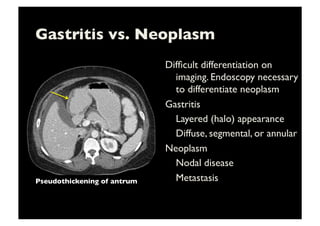 Gastritis vs. Neoplasm	

Difﬁcult differentiation on
imaging. Endoscopy necessary
to differentiate neoplasm	

Gastritis	

	

Layered (halo) appearance	

	

Diffuse, segmental, or annular 	

Neoplasm	

	

Nodal disease	

	

Metastasis	

Pseudothickening of antrum	

 