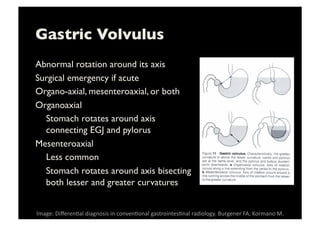 Gastric Volvulus	

Abnormal rotation around its axis	

Surgical emergency if acute	

Organo-axial, mesenteroaxial, or both	

Organoaxial	

	

Stomach rotates around axis
connecting EGJ and pylorus	

Mesenteroaxial	

	

Less common	

	

Stomach rotates around axis bisecting
both lesser and greater curvatures	

Image:	
  Diﬀeren-al	
  diagnosis	
  in	
  conven-onal	
  gastrointes-nal	
  radiology.	
  Burgener	
  FA,	
  Kormano	
  M.	
  
 