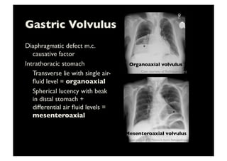 Gastric Volvulus	

Diaphragmatic defect m.c.
causative factor	

Intrathoracic stomach	

	

Transverse lie with single air-
ﬂuid level = organoaxial	

	

Spherical lucency with beak
in distal stomach +
differential air ﬂuid levels =
mesenteroaxial	

Case courtesy of Radiopaedia.org	

Case courtesy of Dr Maxime St-Amant, Radiopaedia.org	

Organoaxial volvulus	

Mesenteroaxial volvulus	

*	
  
*	
  
 