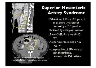Superior Mesenteric 
Artery Syndrome	

Dilatation of 1st and 2nd part of
duodenum with abrupt
narrowing at 3rd portion	

Relieved by changing position	

Aorta-SMA distance 8-10
mm 	

Aortomesenteric angle 22
degrees	

(compression of LRV – renal
vein thrombosis,
pneumatosis, PVG,AAA)	

Narrow aortomesenteric angle and
compression at 3rd portion of duodenum	

 