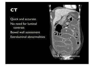 CT	

Quick and accurate	

No need for luminal
contrast	

Bowel wall assessment	

Extraluminal abnormalities	

*	
  
*	
  
*	
  
*	
  
Diffuse, ﬂuid-ﬁlled, dilated loops 	

of small bowel	

Free ﬂuid	

 
