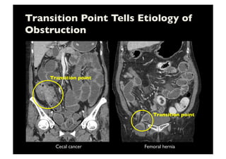 Transition Point Tells Etiology of
Obstruction	

Cecal cancer	

 Femoral hernia	

Transition point	

Transition point	

 
