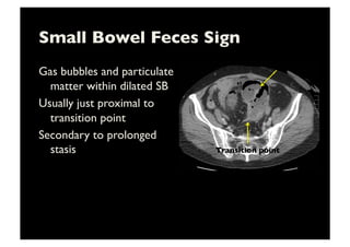 Small Bowel Feces Sign	

Gas bubbles and particulate
matter within dilated SB	

Usually just proximal to
transition point	

Secondary to prolonged
stasis	

 Transition point	

 