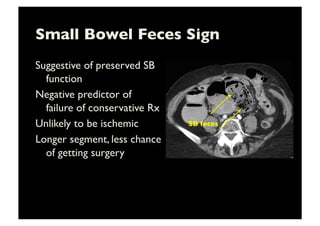Small Bowel Feces Sign	

Suggestive of preserved SB
function	

Negative predictor of
failure of conservative Rx	

Unlikely to be ischemic	

Longer segment, less chance
of getting surgery	

SB feces	

 