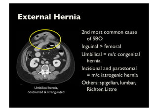 External Hernia	

2nd most common cause
of SBO	

Inguinal  femoral	

Umbilical = m/c congenital
hernia	

Incisional and parastomal
= m/c iatrogenic hernia	

Others: spigelian, lumbar,
Richter, Littre	

Umbilical hernia, 	

obstructed  strangulated	

 