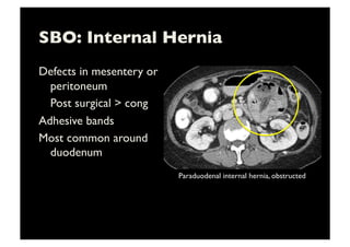 SBO: Internal Hernia	

Defects in mesentery or
peritoneum	

	

Post surgical  cong	

Adhesive bands	

Most common around
duodenum	

Paraduodenal internal hernia, obstructed	

 