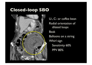 Closed-loop SBO	

U-, C- or coffee bean	

Radial orientation of
dilated loops	

Beak	

Balloons on a string	

Whirl sign	

	

Sensitivity 60%	

	

PPV 80%	

 