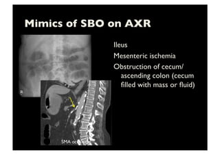 Mimics of SBO on AXR	

Ileus	

Mesenteric ischemia	

Obstruction of cecum/
ascending colon (cecum
ﬁlled with mass or ﬂuid)	

SMA occlusion	

 