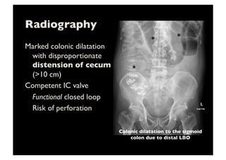 Radiography	

Marked colonic dilatation
with disproportionate
distension of cecum
(10 cm)	

Competent IC valve	

	

Functional closed loop	

	

Risk of perforation	

*	
   *	
  
*	
  
Colonic dilatation to the sigmoid
colon due to distal LBO	

 