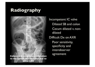 Radiography	

Incompetent IC valve	

	

Dilated SB and colon	

	

Cecum dilated v. non-
dilated	

Difﬁcult Dx on AXR	

	

Poor sensitivity,
speciﬁcity and
interobserver
agreement	

*	
   *	
  
Colonic and small bowel dilatation
to the splenic ﬂexure colon due to
distal LBO	

*	
  
 
