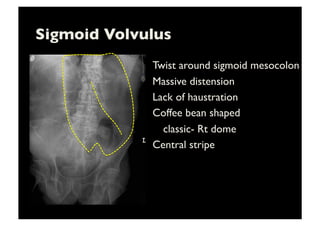 Sigmoid Volvulus	

Twist around sigmoid mesocolon	

Massive distension	

Lack of haustration	

Coffee bean shaped	

	

classic- Rt dome	

Central stripe	

 