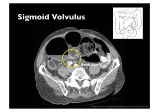 Sigmoid Volvulus	

Diagrams from surgeonsblog.blogspot.com and pmj.bmj.com	

Beak sign	

 