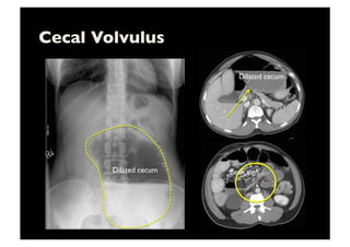 Cecal Volvulus	

Dilated cecum	

Dilated cecum	

Beak sign	

 