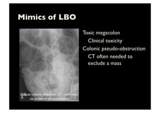 Mimics of LBO	

Toxic megacolon	

	

Clinical toxicity	

Colonic pseudo-obstruction	

	

CT often needed to
exclude a mass	

Diffuse colonic dilatation. CT conﬁrmed
no evidence of obstruction	

 