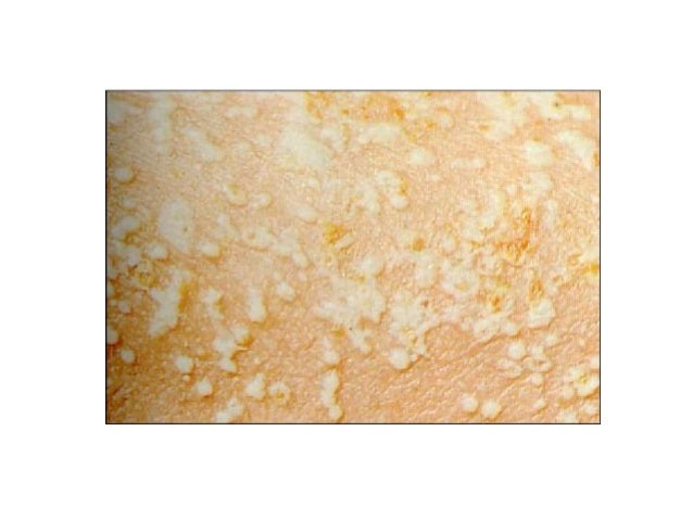 Handout Morfologi Dan Terminologi Penyakit Kulit 1