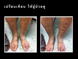 เ ป รี ย บ เ ที ย บ ใ ห้ ผู้ ป่ ว ย ดู
 